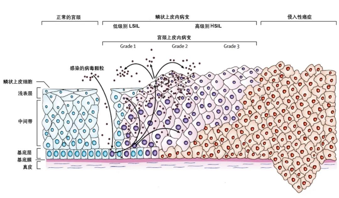 宫颈癌，女性朋友一定“药”小心！